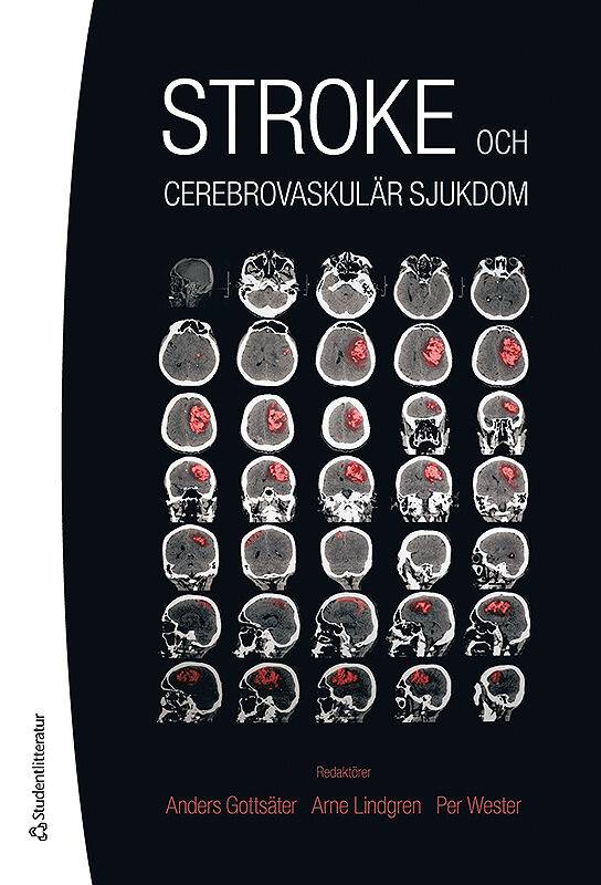 Stroke - och cerebrovaskulär sjukdom