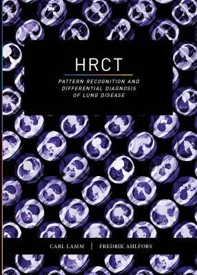 HRCT : pattern recognition and differential diagnosis of lung disease